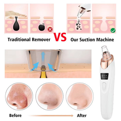 Electric Blackhead Remover Vacuum – Deep Pore Cleanser & Face Care Tool