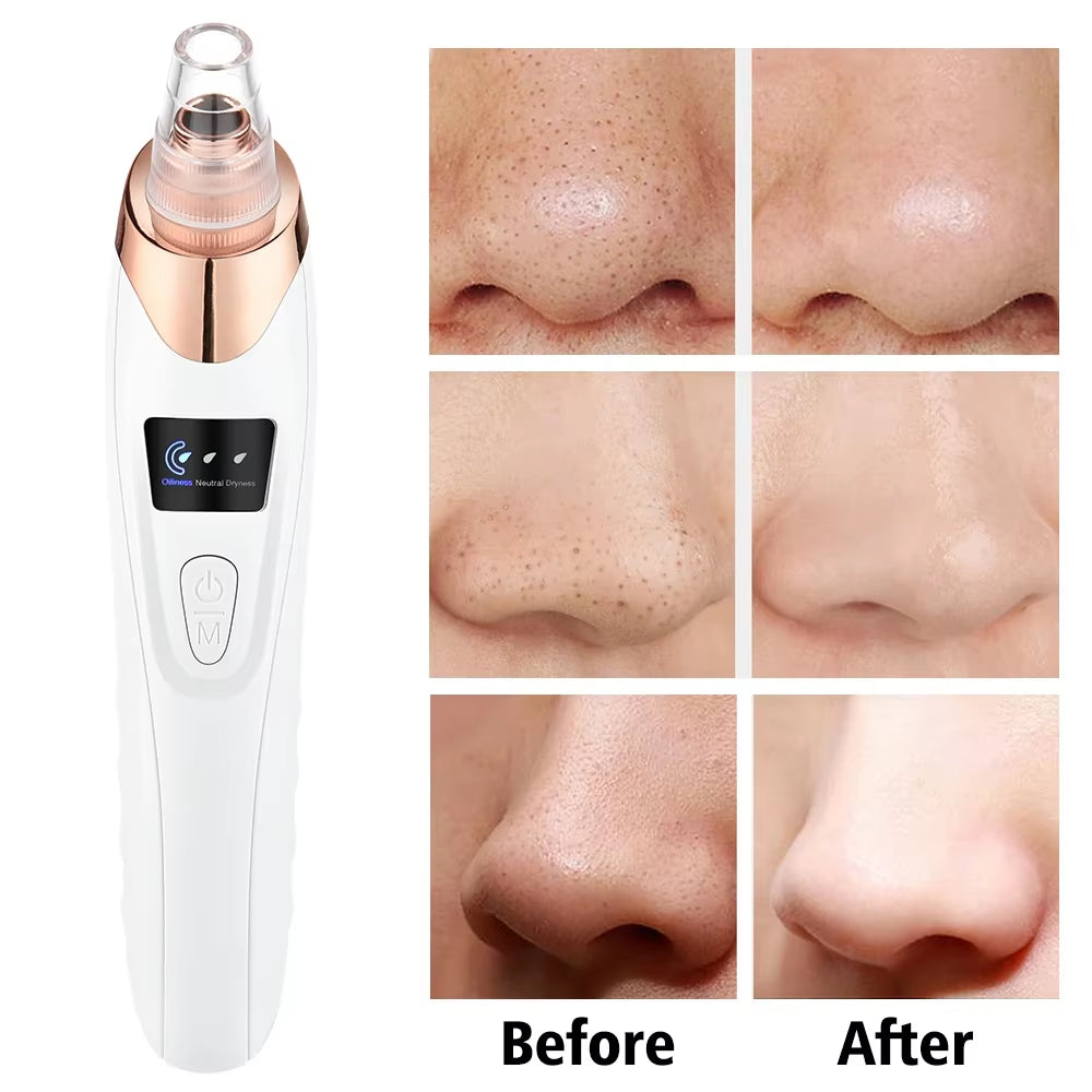 Electric Blackhead Remover Vacuum – Deep Pore Cleanser & Face Care Tool